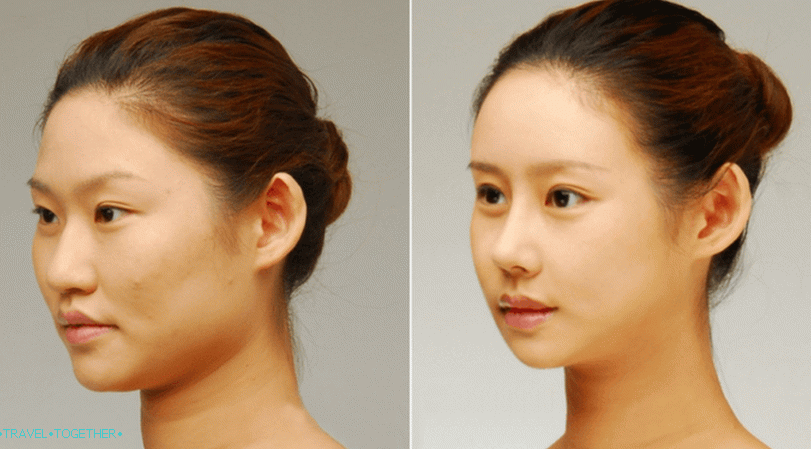 Blepharoplastika v Thajsku